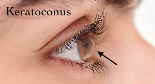 keratoconus & scleral lens in cambridge